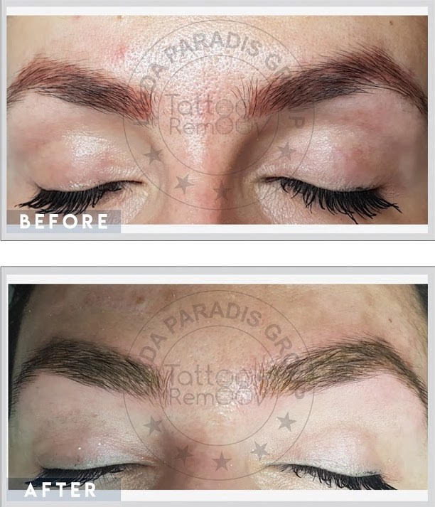 MezMarieEyes  Magnetic  Tattoo Removal 88  2 sessions  Facebook